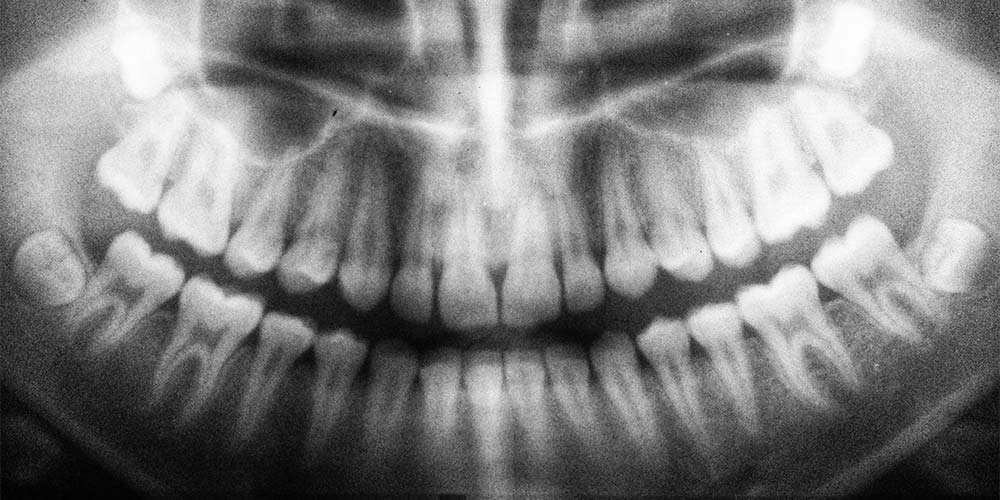 X-ray of the jaw showing teeth