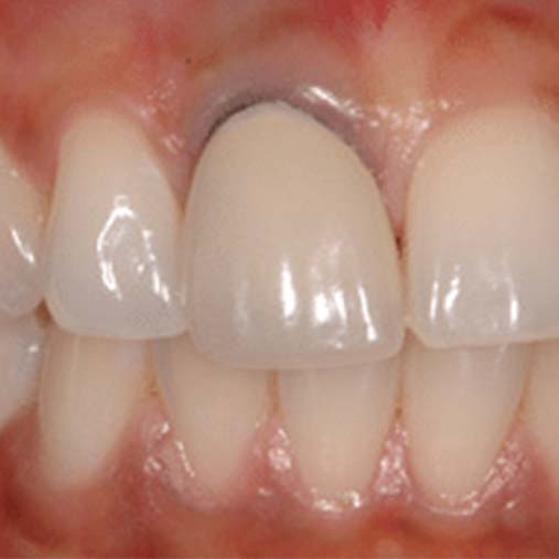 crowns veneers dentist