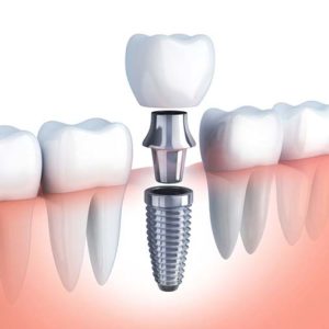 A 3D diagram showing how dental implants sit beneath the jaw line