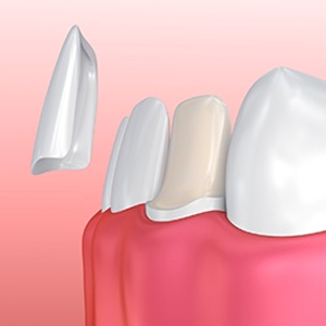 Porcelain Veneers