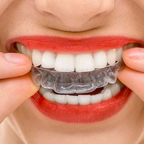 Invisalign Clear Retainer