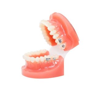 A model of ceramic braces