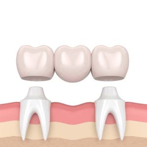 Dental Bridge