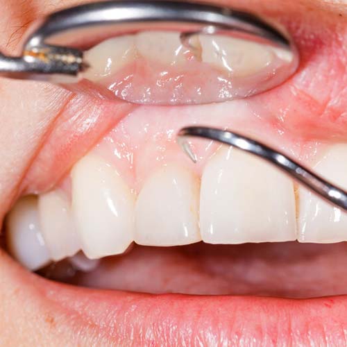 An up close photo of a gum being inspected by a dentist