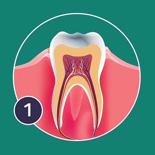 A diagram of gingivitis impacting tooth health