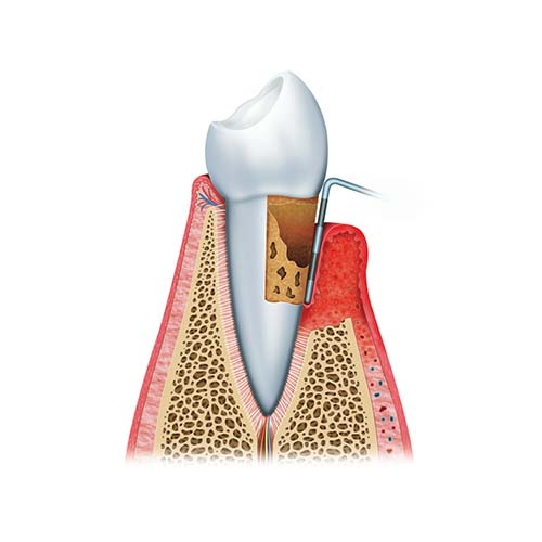 A diagram showing a tooth being inspected for gum disease