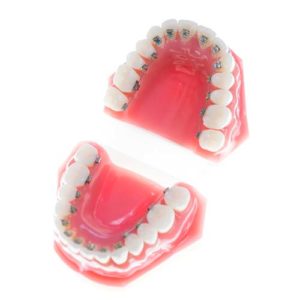 Jaw displaying Lingual braces appearing on the inside of the teeth