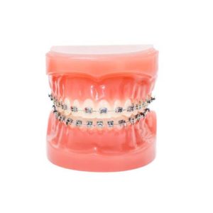 Metal braces displayed on a tooth model