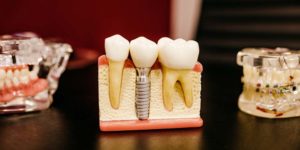 dental implants