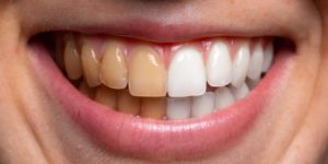 Teeth Whitening Sydney