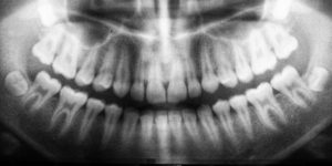 dental x-rays