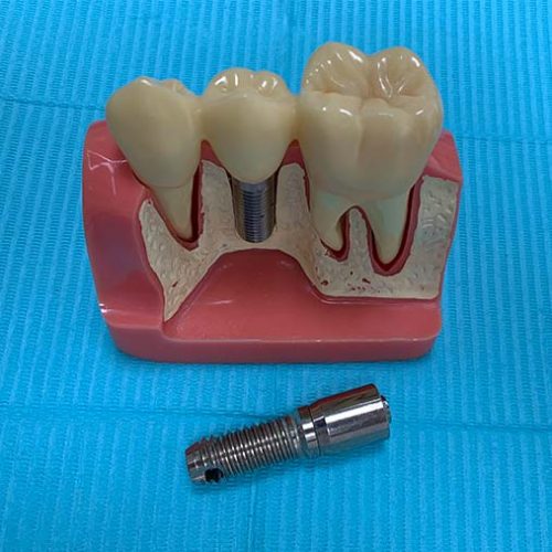 Dental Implants An enlarged model of Dental Implants