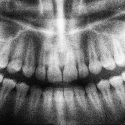 X-ray of the jaw showing teeth